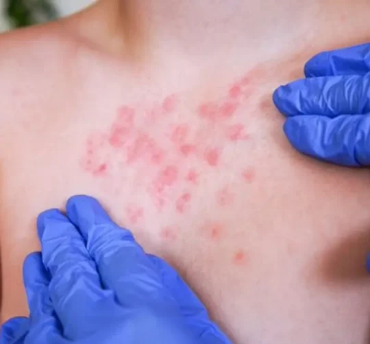 México confirmó tres nuevos fallecimientos a causa del brote de sarampión.