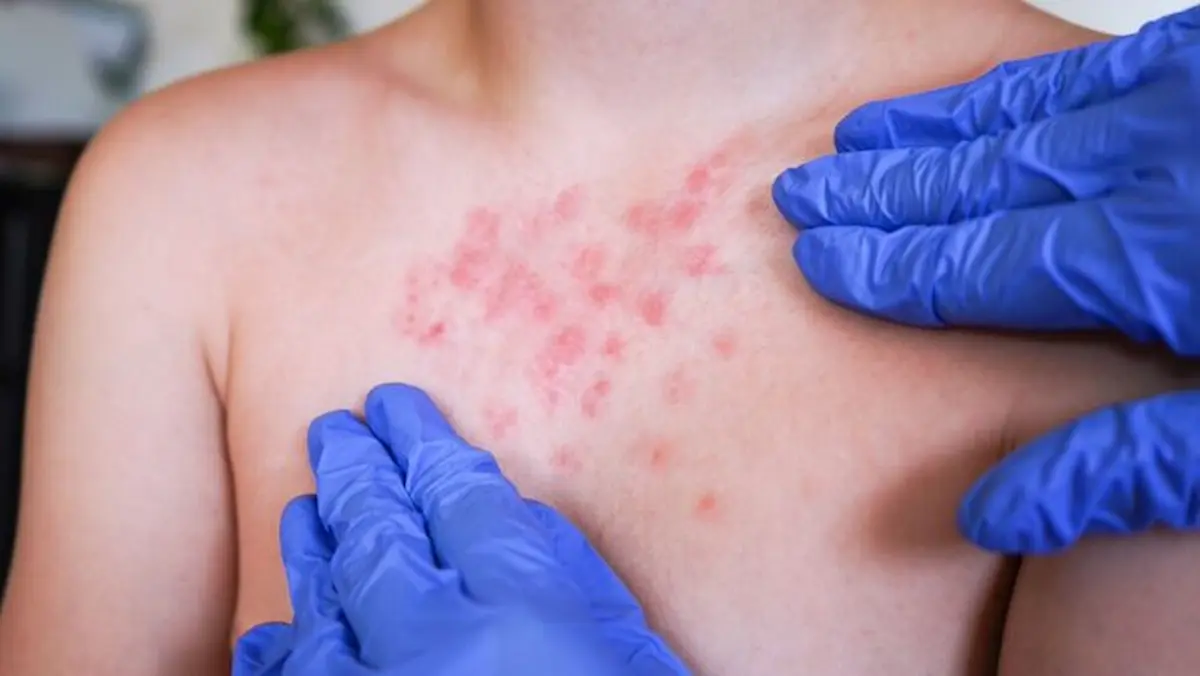 México confirmó tres nuevos fallecimientos a causa del brote de sarampión.