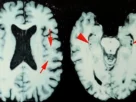 Imágenes de un cerebro afectado por encefalopatía traumática crónica (ETC)