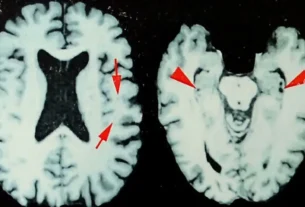 Imágenes de un cerebro afectado por encefalopatía traumática crónica (ETC)