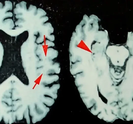 Imágenes de un cerebro afectado por encefalopatía traumática crónica (ETC)