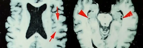 Imágenes de un cerebro afectado por encefalopatía traumática crónica (ETC)