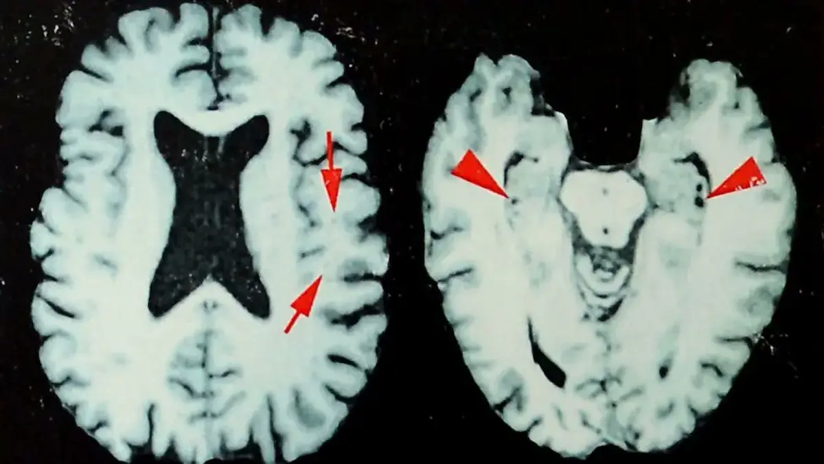 Imágenes de un cerebro afectado por encefalopatía traumática crónica (ETC)